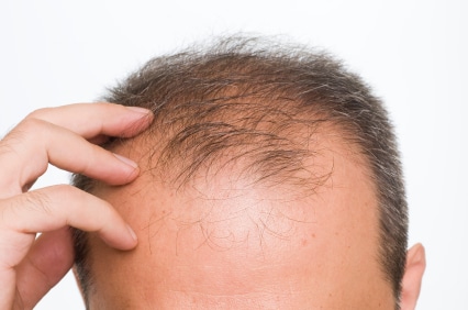 FDA approved treatments for hair loss